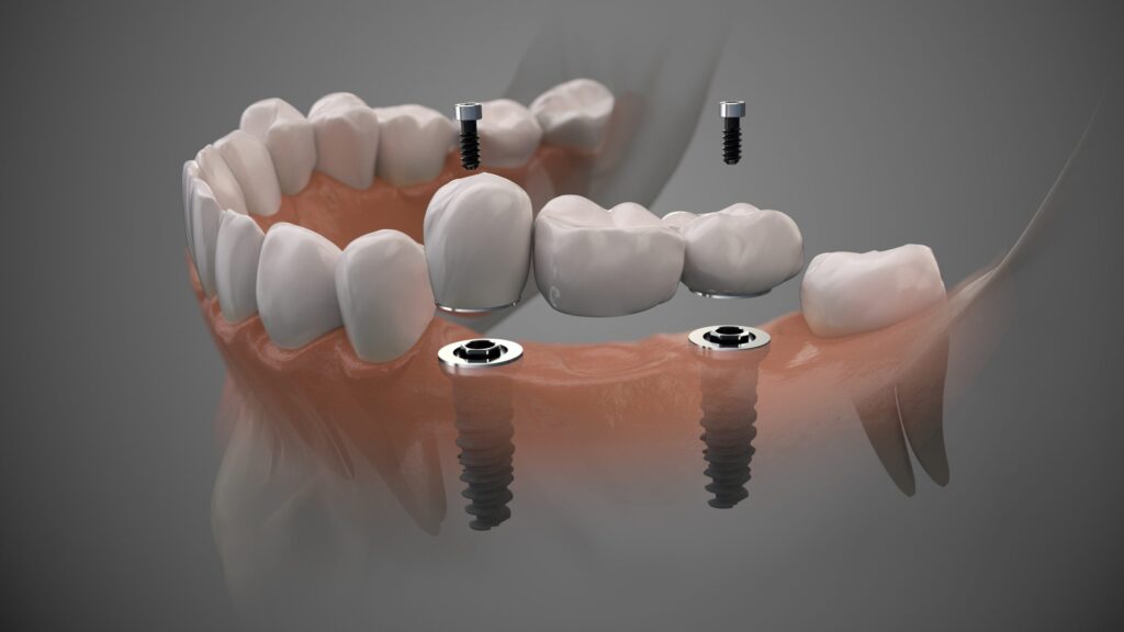 model showing dental implant placement