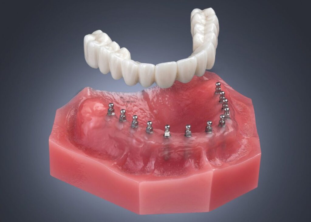 Full Mouth Dental Implants