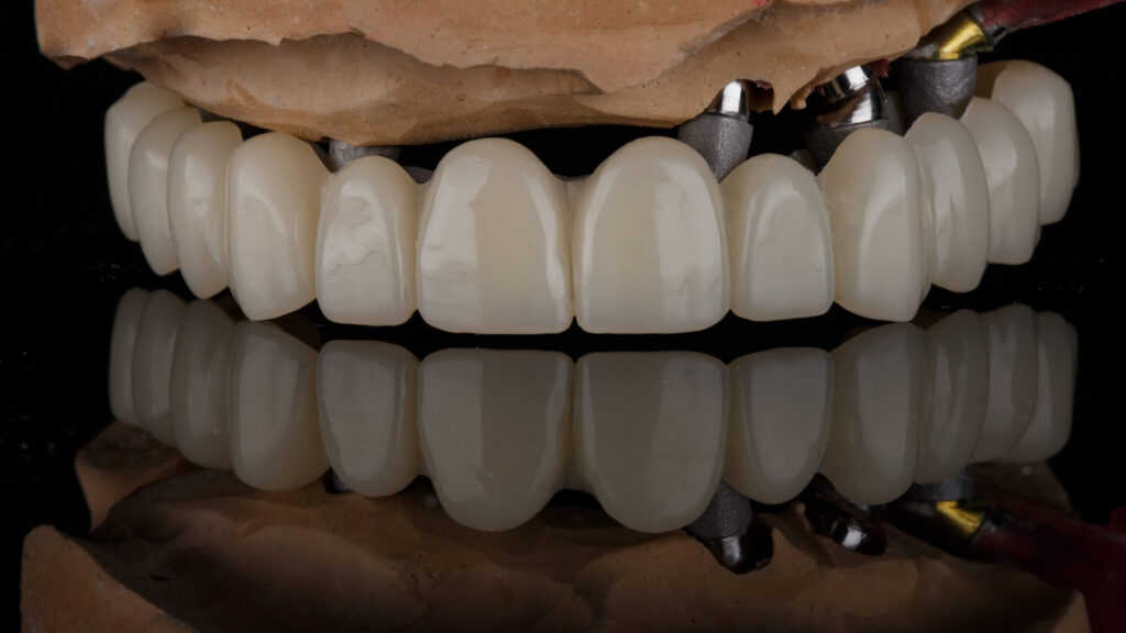 Full Mouth Dental Implants