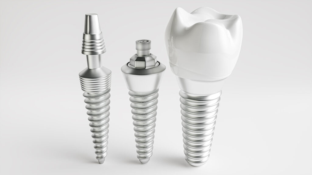 dental implant