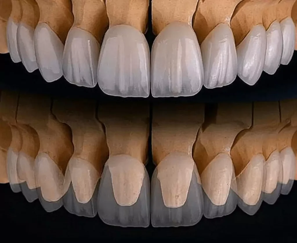 dental crown