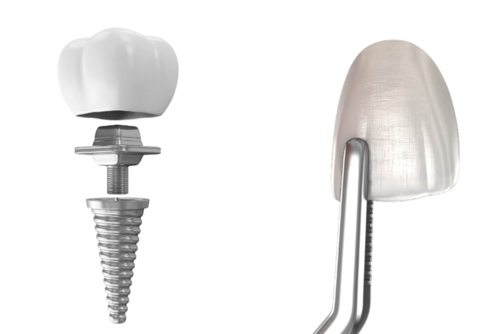 implant treatment payment