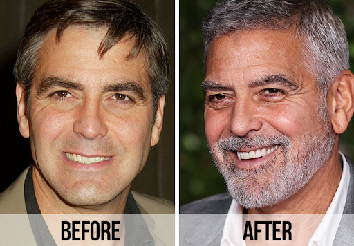 George Clooney Teeth before and after
