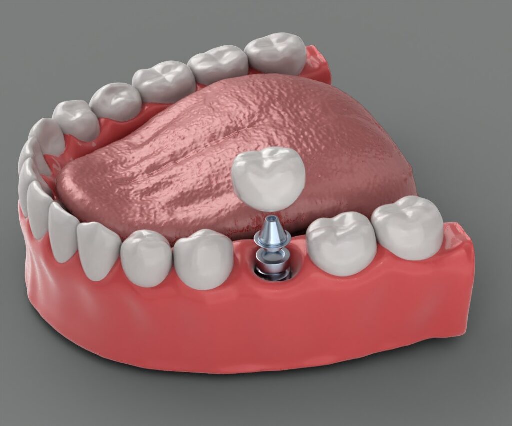single tooth implant