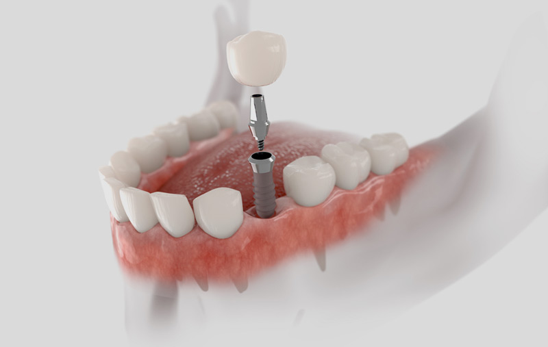 Placement of a single implant on a 3D model of the palate