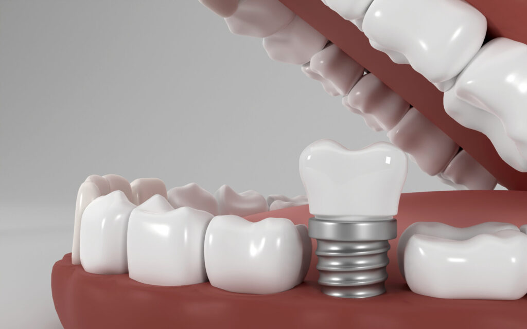 3D model visual showing the placement of the implant used in dental treatment in the jaw
