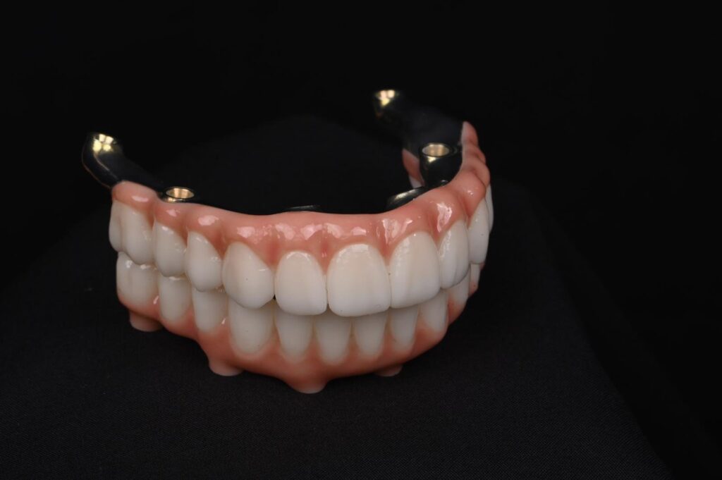 full teeth implant modeli