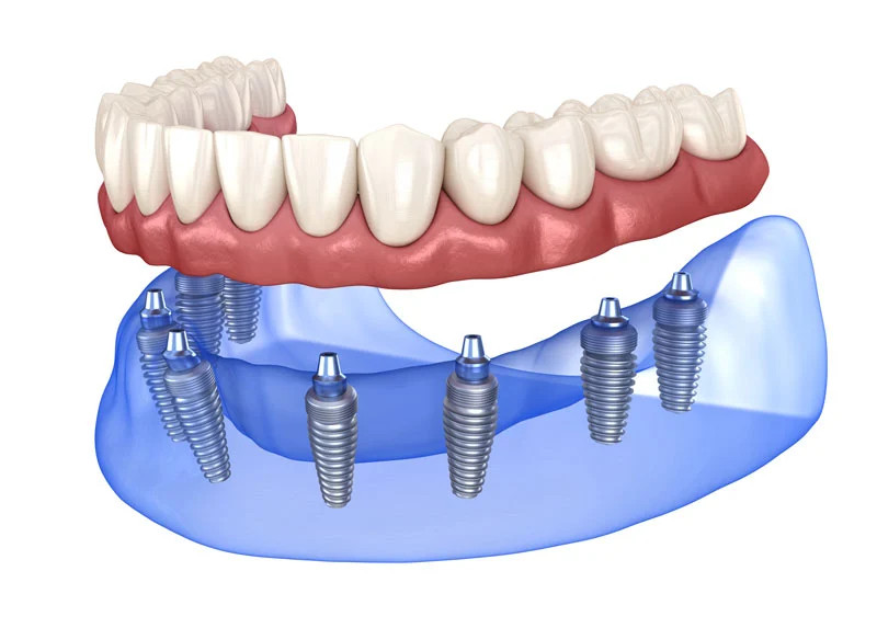Image of placing a full mouth denture on 8 implants