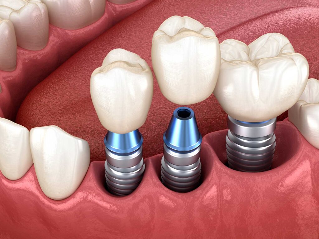 Getting a dental implant in Turkey, image of a dental implant placed in the mouth