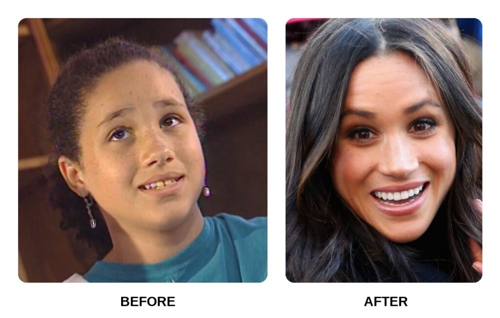 Meghan Markles teeth