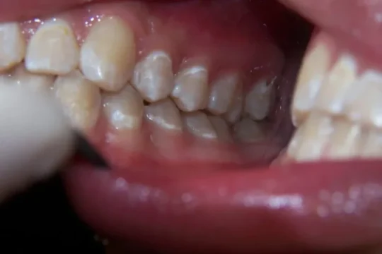 How to Protect Your Teeth from Acid Erosion