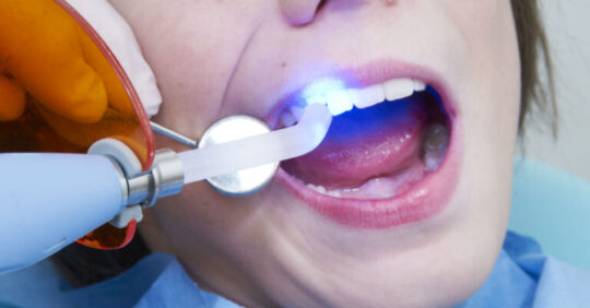 Sealing Teeth Is Unhealthy?