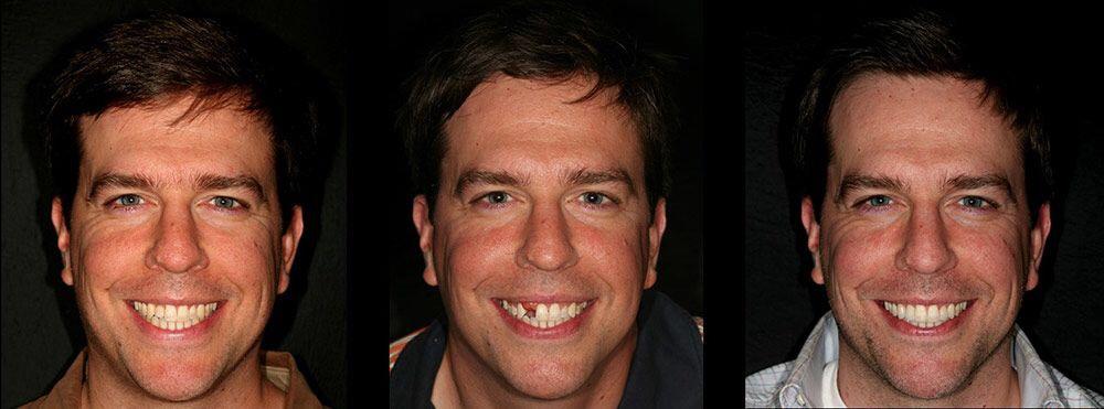 ed helms teeth