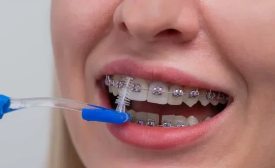 How to Avoid Tooth Decay While Wearing Braces