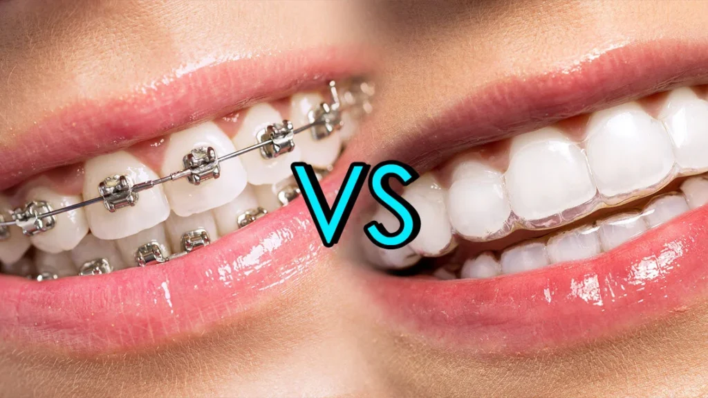 Braces vs. Invisalign