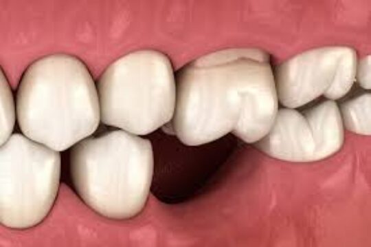 What Should Be Done For Loose Teeth