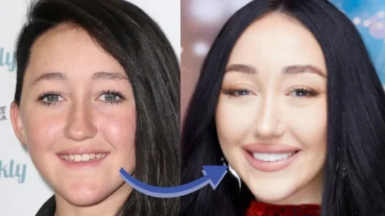 Noah Cyrus Teeth: Before and After