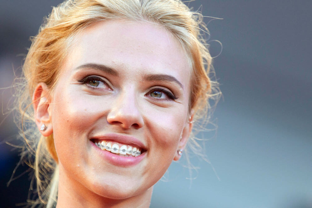 scarlett johansson teeth