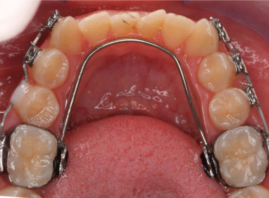 What Does a Spacer Do for Teeth?