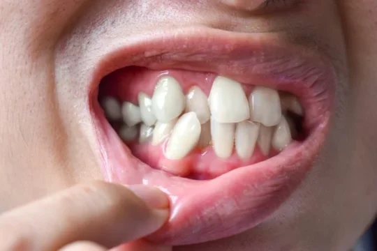 What Is Supernumerary Teeth? Treatments, Types
