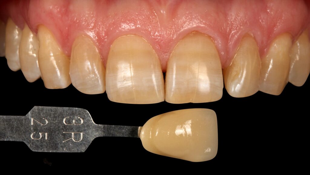 Tetracycline Teeth