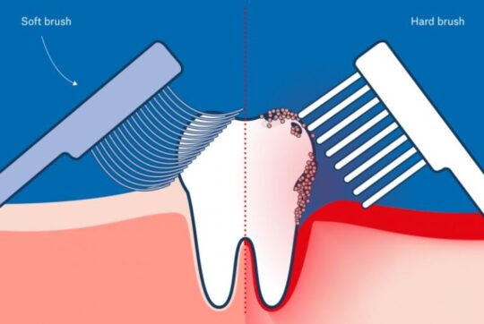 Hard Toothbrush or Soft Toothbrush: Which One Is Better?